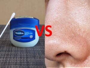 いちご鼻にはワセリンと綿棒がいいってホント!?その噂、実際に検証してみた