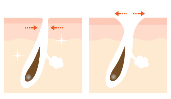 開き毛穴ができるメカニズム