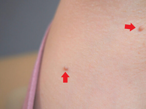 腕の付け根の大きなイボに塗布