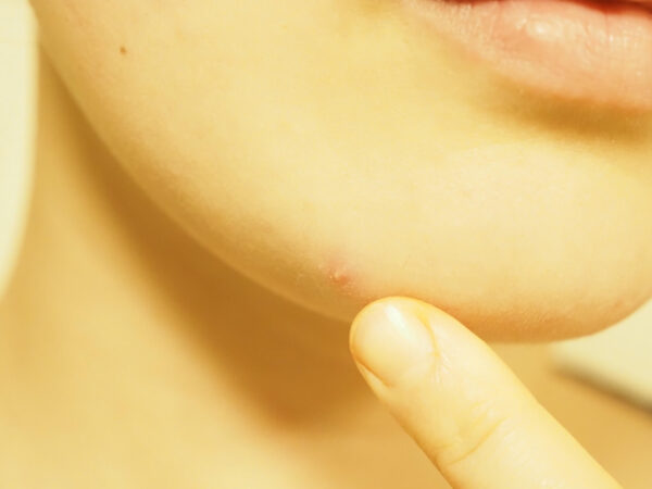 ニキビが治った人がいるの?