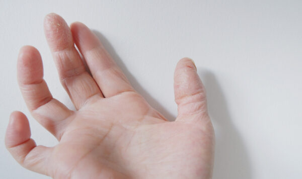爪の縦線の原因