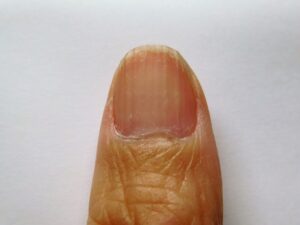 爪の縦線の原因は？予防や対処法を解説。セラミドオイルによるネイルケアを写真付きレポート