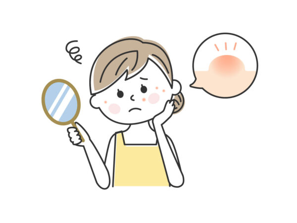 ストレス性肌荒れに特徴的な症状