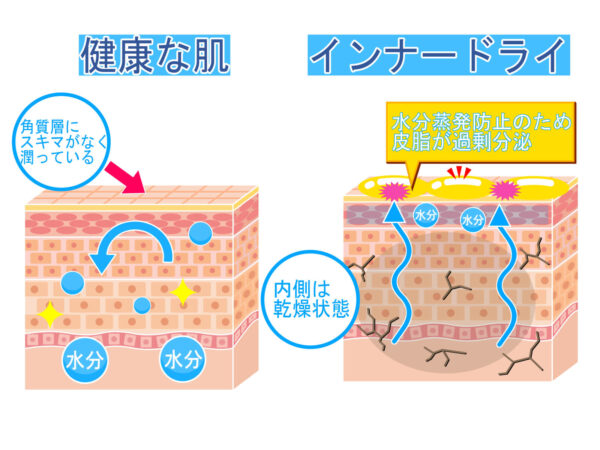 水分不足と過剰皮脂は、8:2の理想バランスが崩れると起こります。