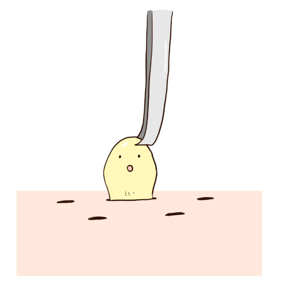 角栓をピンセットや指で無理やり押し出す