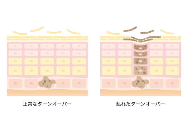 肌の防御反応！傷ついた細胞を排出する「ターンオーバーの暴走」