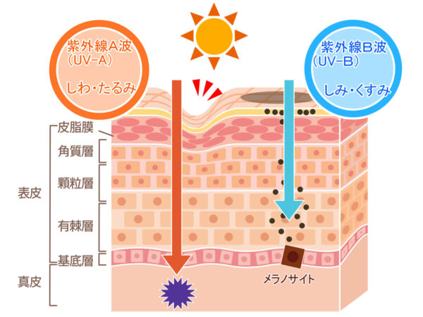 原因は強力な紫外線「UVB」による“やけど”状態