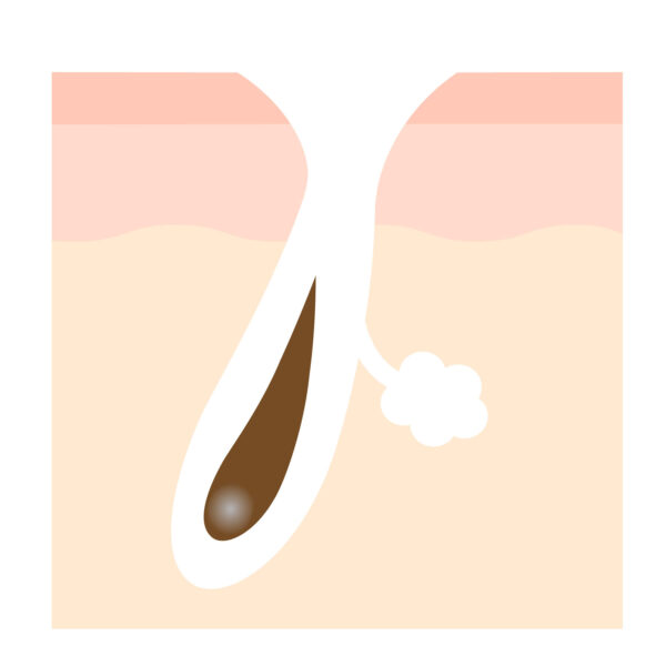皮脂で丸く開いている「開き毛穴」