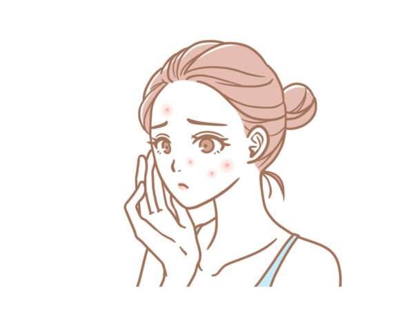 【抗炎症作用】ニキビや肌荒れなどの肌トラブルを鎮静
