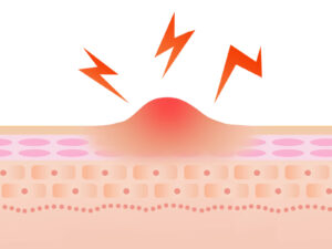 【症状】炎症が強く、しこりになりやすい