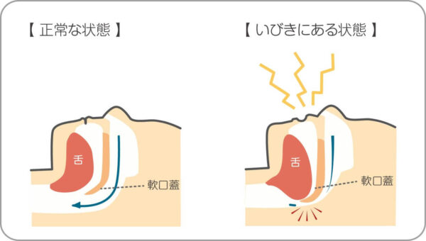 睡眠時無呼吸症候群(SAS):いびきや呼吸停止の指摘はないか