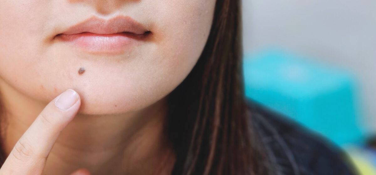 「色白でほくろが多い」はコンプレックス？原因と対策、チャームポイントに変える方法を解説