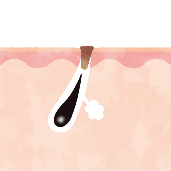 【詰まり毛穴タイプ】ザラつきや黒ずみが気になる