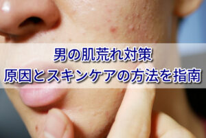 男の肌荒れ対策｜原因とメンズスキンケアの方法を指南